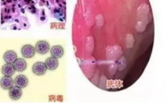 尖锐湿疣的初期症状,如何早期识别与预防